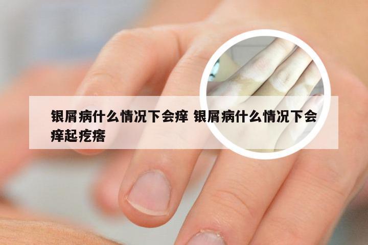 银屑病什么情况下会痒 银屑病什么情况下会痒起疙瘩