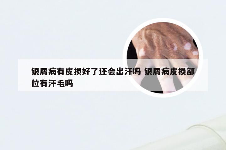 银屑病有皮损好了还会出汗吗 银屑病皮损部位有汗毛吗