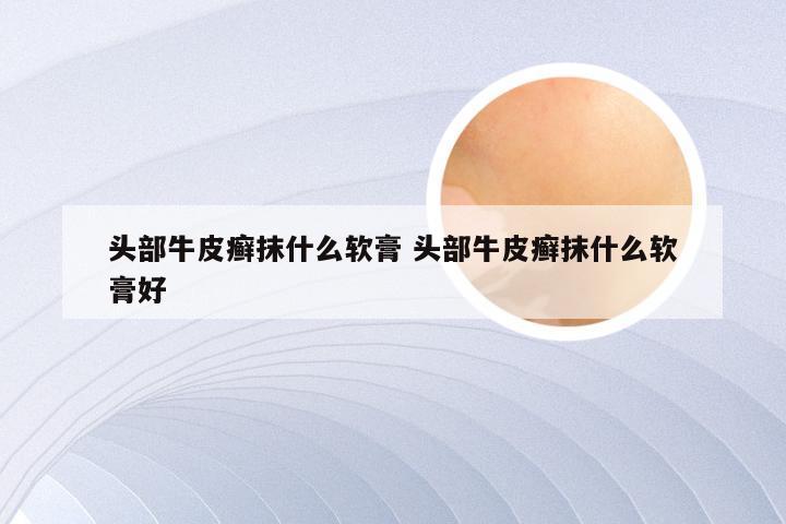 头部牛皮癣抹什么软膏 头部牛皮癣抹什么软膏好