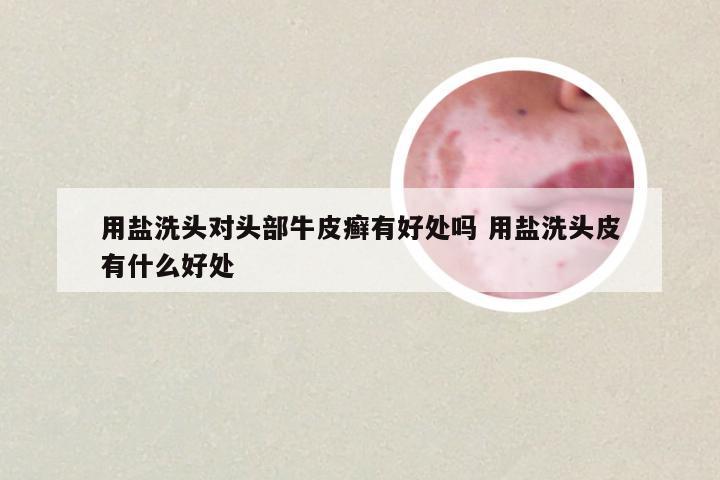用盐洗头对头部牛皮癣有好处吗 用盐洗头皮有什么好处