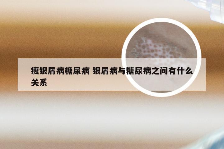 瘦银屑病糖尿病 银屑病与糖尿病之间有什么关系
