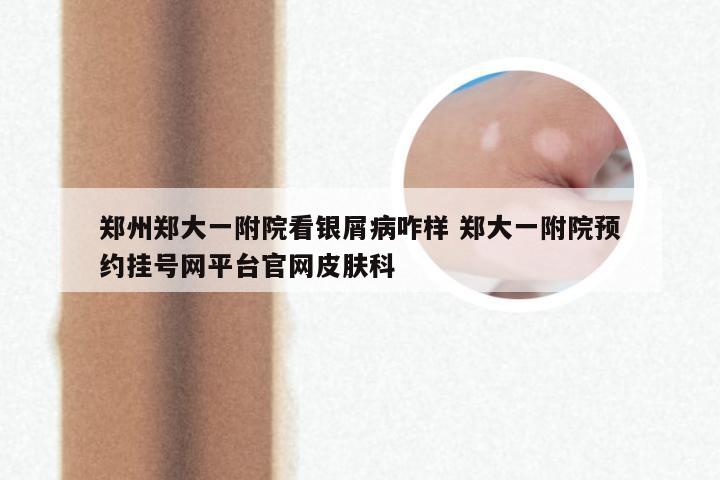 郑州郑大一附院看银屑病咋样 郑大一附院预约挂号网平台官网皮肤科