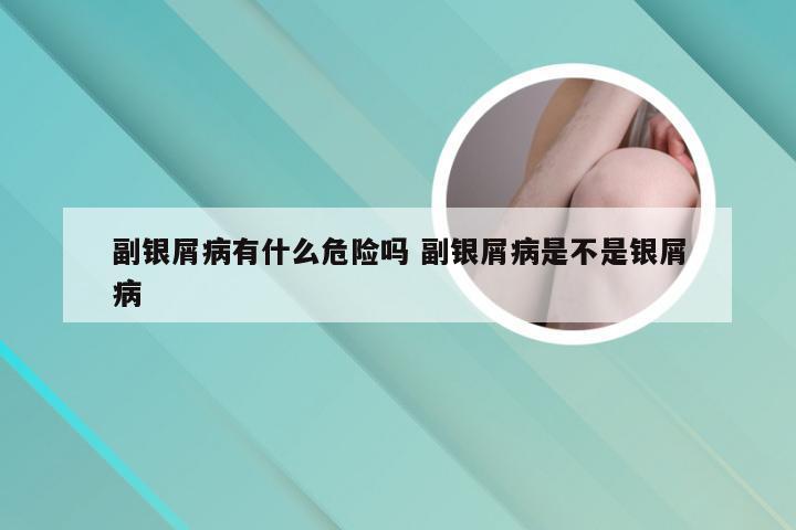 副银屑病有什么危险吗 副银屑病是不是银屑病