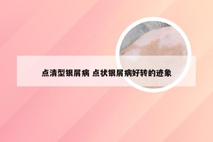 点清型银屑病 点状银屑病好转的迹象