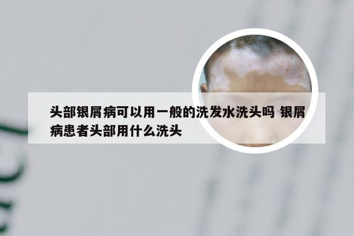 头部银屑病可以用一般的洗发水洗头吗 银屑病患者头部用什么洗头