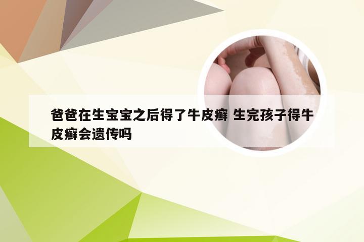 爸爸在生宝宝之后得了牛皮癣 生完孩子得牛皮癣会遗传吗
