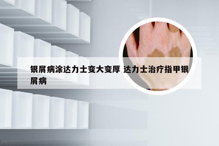 银屑病涂达力士变大变厚 达力士治疗指甲银屑病