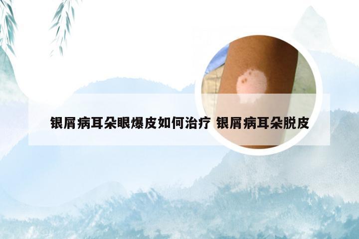 银屑病耳朵眼爆皮如何治疗 银屑病耳朵脱皮