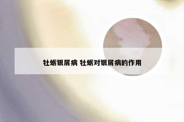牡蛎银屑病 牡蛎对银屑病的作用