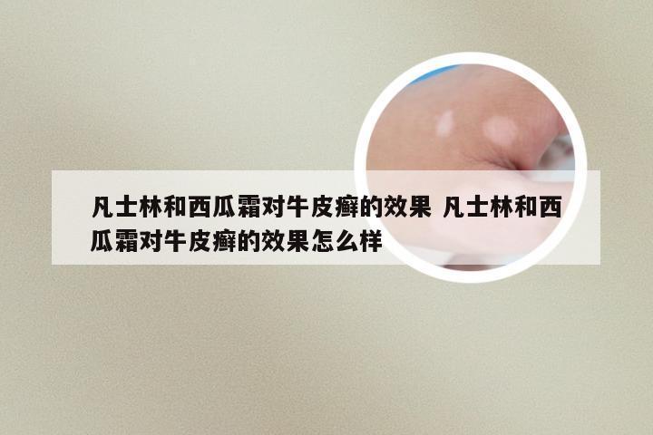 凡士林和西瓜霜对牛皮癣的效果 凡士林和西瓜霜对牛皮癣的效果怎么样