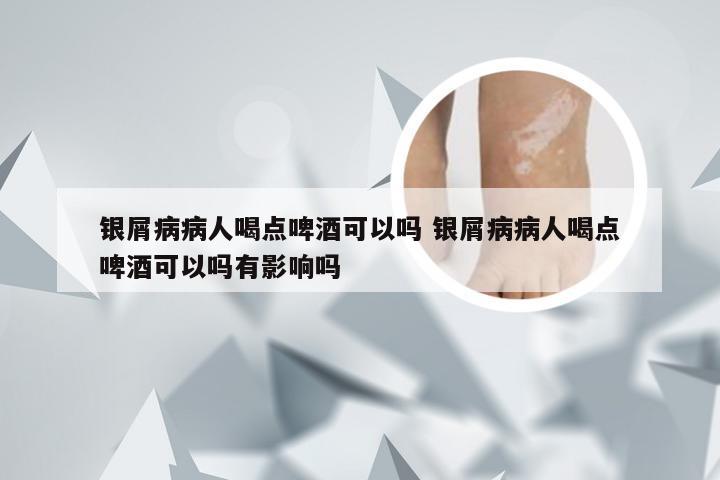 银屑病病人喝点啤酒可以吗 银屑病病人喝点啤酒可以吗有影响吗