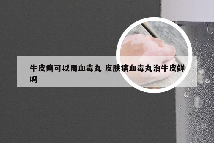 牛皮癣可以用血毒丸 皮肤病血毒丸治牛皮鲜吗