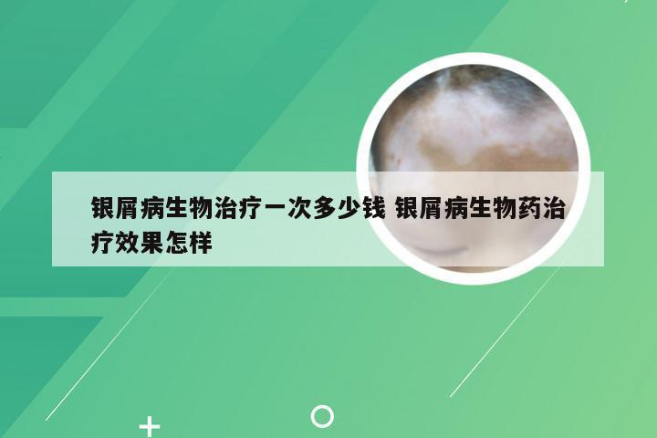 银屑病生物治疗一次多少钱 银屑病生物药治疗效果怎样