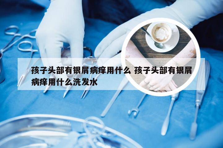孩子头部有银屑病痒用什么 孩子头部有银屑病痒用什么洗发水