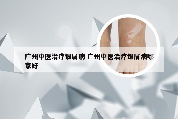 广州中医治疗银屑病 广州中医治疗银屑病哪家好