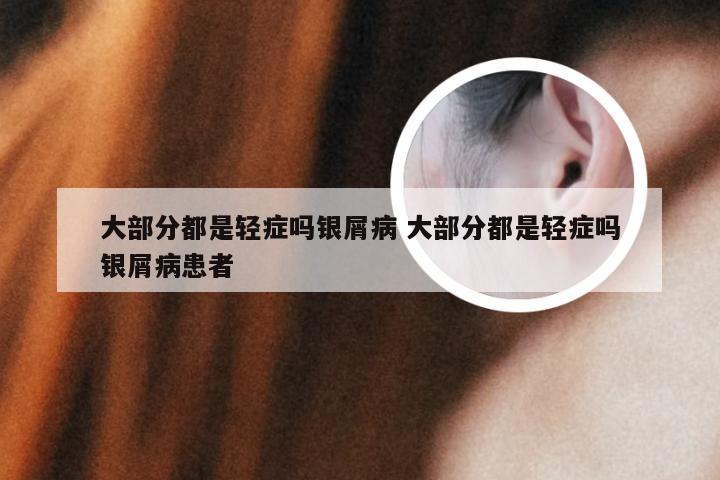 大部分都是轻症吗银屑病 大部分都是轻症吗银屑病患者