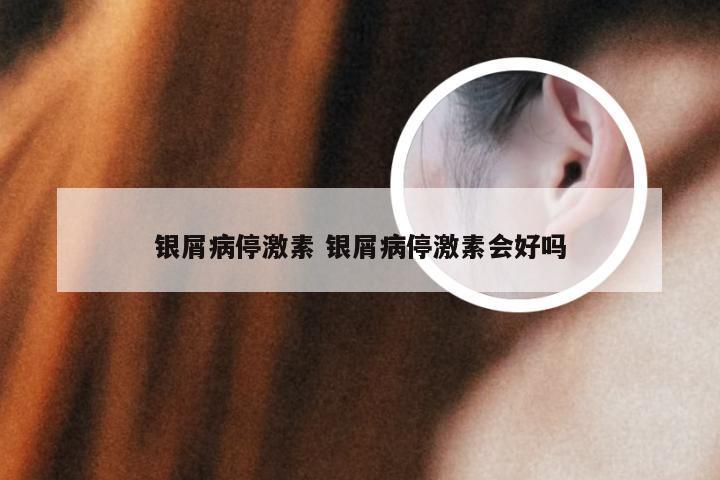 银屑病停激素 银屑病停激素会好吗