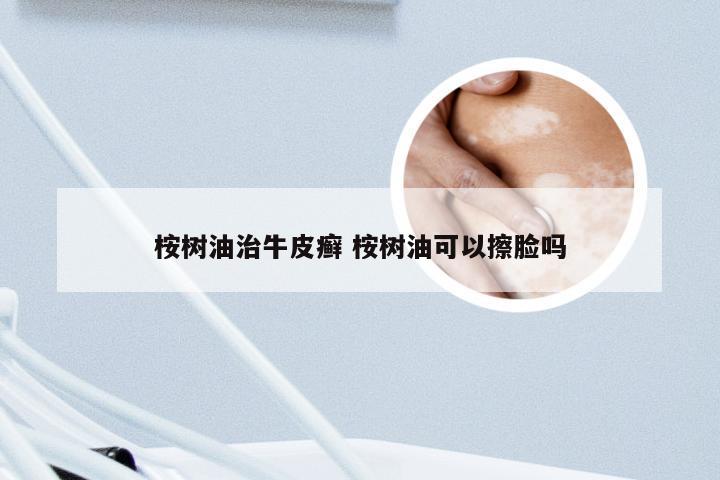桉树油治牛皮癣 桉树油可以擦脸吗