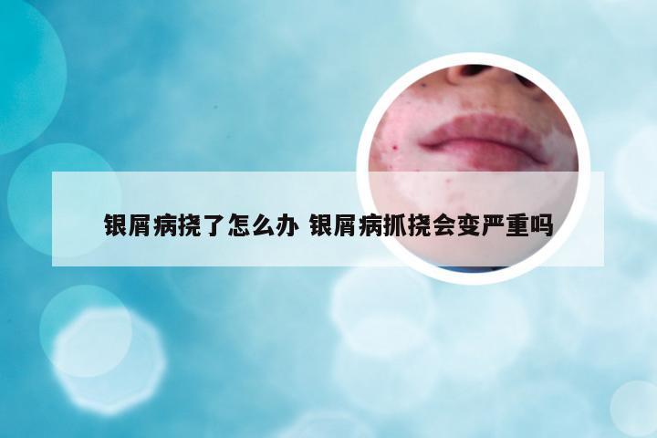 银屑病挠了怎么办 银屑病抓挠会变严重吗