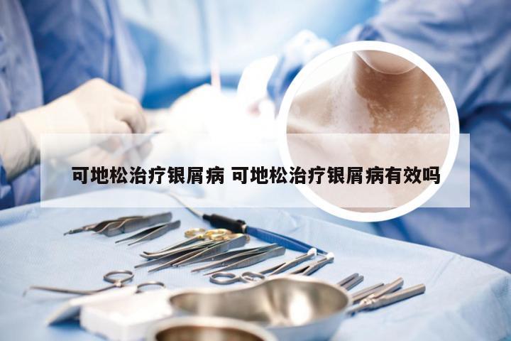 可地松治疗银屑病 可地松治疗银屑病有效吗