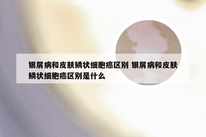 银屑病和皮肤鳞状细胞癌区别 银屑病和皮肤鳞状细胞癌区别是什么