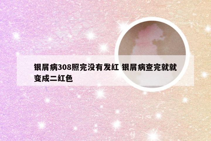 银屑病308照完没有发红 银屑病查完就就变成二红色