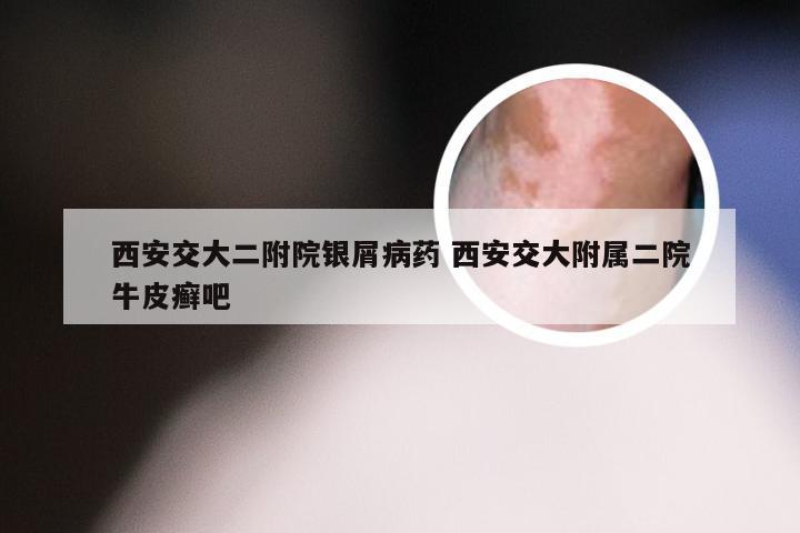 西安交大二附院银屑病药 西安交大附属二院牛皮癣吧