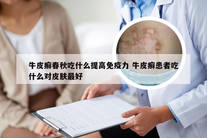 牛皮癣春秋吃什么提高免疫力 牛皮癣患者吃什么对皮肤最好