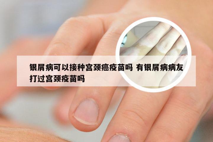 银屑病可以接种宫颈癌疫苗吗 有银屑病病友打过宫颈疫苗吗