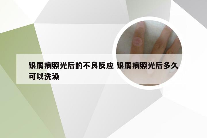 银屑病照光后的不良反应 银屑病照光后多久可以洗澡