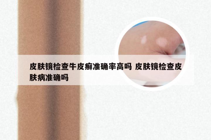 皮肤镜检查牛皮癣准确率高吗 皮肤镜检查皮肤病准确吗