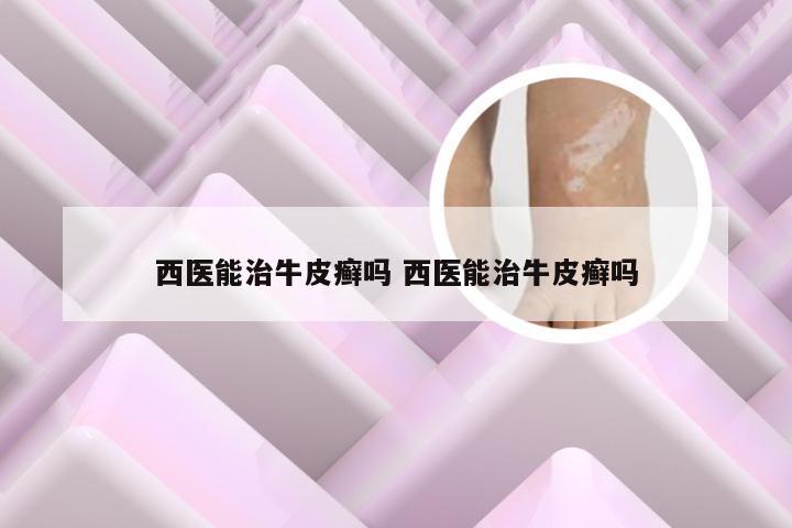 西医能治牛皮癣吗 西医能治牛皮癣吗