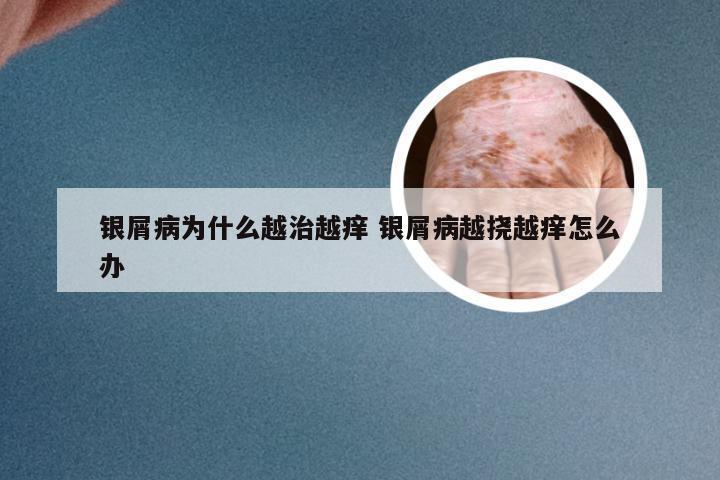 银屑病为什么越治越痒 银屑病越挠越痒怎么办
