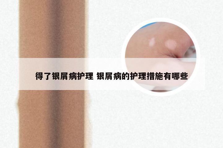 得了银屑病护理 银屑病的护理措施有哪些