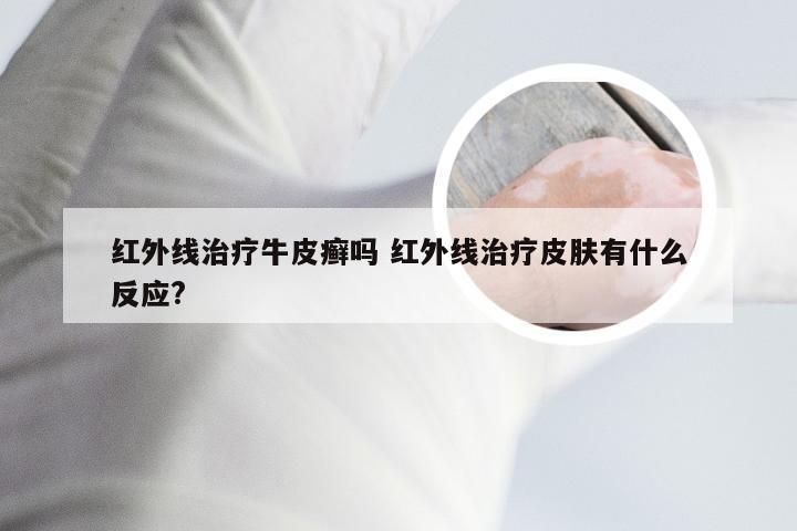 红外线治疗牛皮癣吗 红外线治疗皮肤有什么反应?