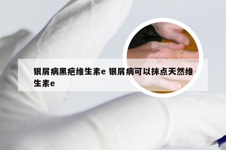 银屑病黑疤维生素e 银屑病可以抹点天然维生素e