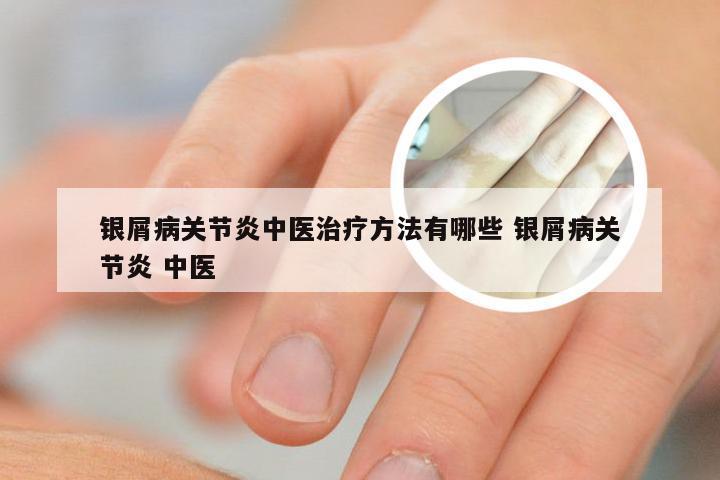 银屑病关节炎中医治疗方法有哪些 银屑病关节炎 中医