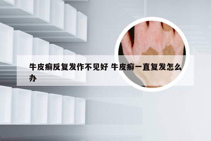 牛皮癣反复发作不见好 牛皮癣一直复发怎么办