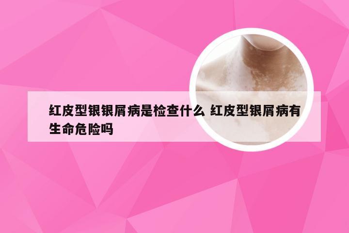 红皮型银银屑病是检查什么 红皮型银屑病有生命危险吗
