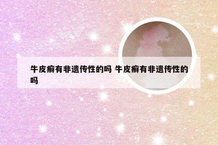 牛皮癣有非遗传性的吗 牛皮癣有非遗传性的吗