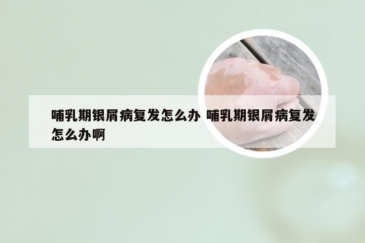 哺乳期银屑病复发怎么办 哺乳期银屑病复发怎么办啊