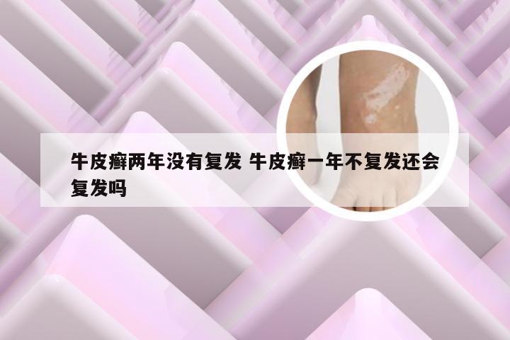 牛皮癣两年没有复发 牛皮癣一年不复发还会复发吗