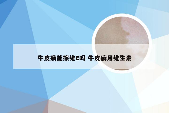 牛皮癣能擦维E吗 牛皮癣用维生素