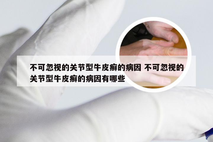 不可忽视的关节型牛皮癣的病因 不可忽视的关节型牛皮癣的病因有哪些