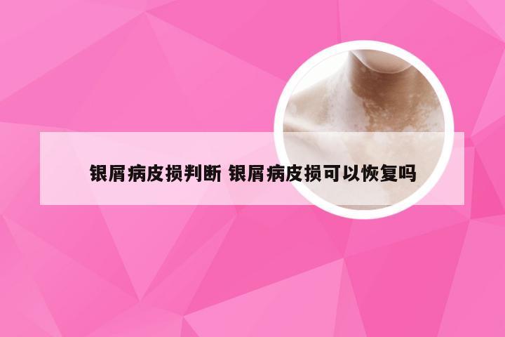 银屑病皮损判断 银屑病皮损可以恢复吗