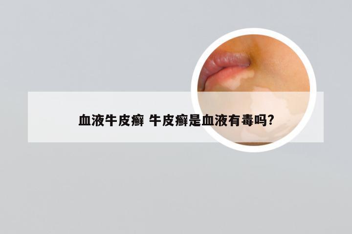 血液牛皮癣 牛皮癣是血液有毒吗?
