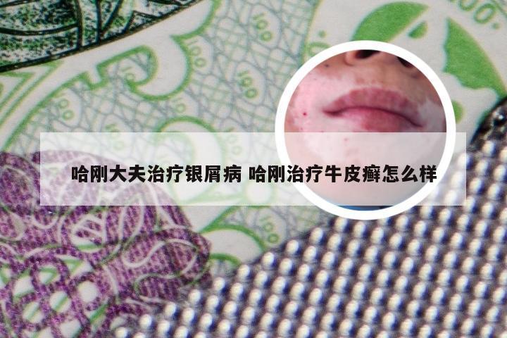 哈刚大夫治疗银屑病 哈刚治疗牛皮癣怎么样