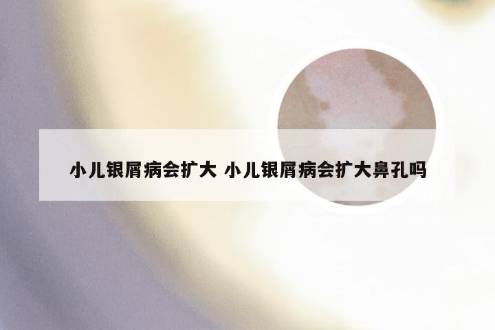 小儿银屑病会扩大 小儿银屑病会扩大鼻孔吗