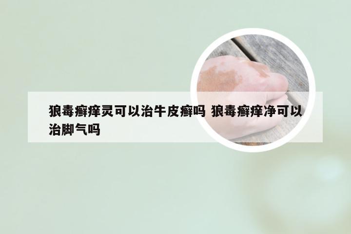 狼毒癣痒灵可以治牛皮癣吗 狼毒癣痒净可以治脚气吗