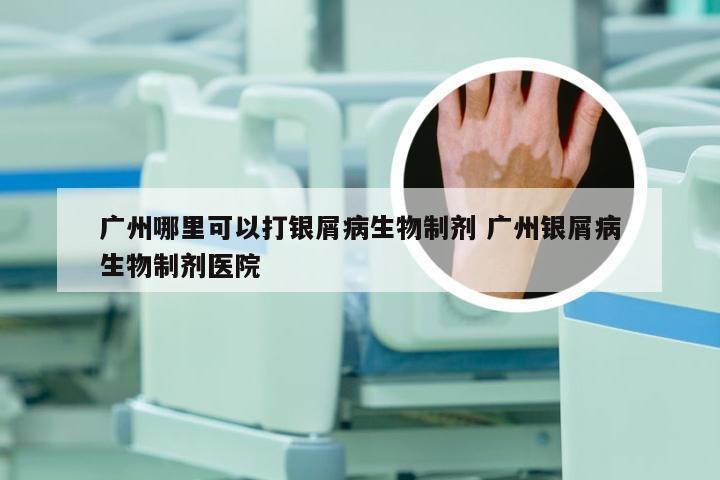 广州哪里可以打银屑病生物制剂 广州银屑病生物制剂医院
